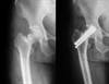 Alendronate Lowers Risk of Hip Fracture in Older Patients Alendronate Lowers Risk of Hip Fracture in Older Patients