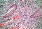 Systemic Lupus Erythematosus Increases Incidence of High-Risk HPV Systemic Lupus Erythematosus Increases Incidence of High-Risk HPV