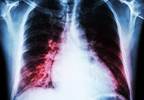 Rheumatoid Arthritis Increases Risk of Cardiovascular Disease Events After Fragility Fracture Rheumatoid Arthritis Increases Risk of Cardiovascular Disease Events After Fragility Fracture