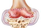 Combination Therapy for Knee Osteoarthritis Inferior to Placebo Combination Therapy for Knee Osteoarthritis Inferior to Placebo