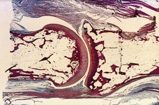 The clinical and radiographic course of early undifferentiated arthritis is not dependent on the presence of erosions in ≥3 joints at diagnosis. The clinical and radiographic course of early undifferentiated arthritis is not dependent on the presence of erosions in ≥3 joints at diagnosis.