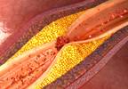 Do Risk Prediction Tools Underestimate Incidence of Carotid Plaque in Gout? Do Risk Prediction Tools Underestimate Incidence of Carotid Plaque in Gout?