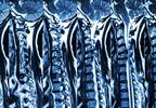 Patients Underestimate Radiation Involved in Spinal Imaging Patients Underestimate Radiation Involved in Spinal Imaging