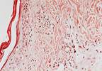 Juvenile Dermatomyositis Management Recommendations Established Juvenile Dermatomyositis Management Recommendations Established