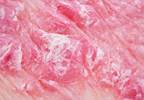 Tofacitinib May Reduce Disease Activity in Active Psoriatic Arthritis Tofacitinib May Reduce Disease Activity in Active Psoriatic Arthritis