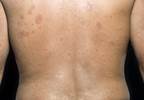 Non-Adjuvanted Influenza A H1N1 Vaccine Safe, Efficacious in Patients With Systemic Sclerosis Non-Adjuvanted Influenza A H1N1 Vaccine Safe, Efficacious in Patients With Systemic Sclerosis