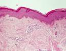 Rituximab Safe and Efficacious Alternative Treatment for Scleroderma Rituximab Safe and Efficacious Alternative Treatment for Scleroderma
