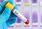No Increased Risk of SLE With Current Use of Statin Therapy No Increased Risk of SLE With Current Use of Statin Therapy