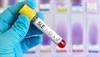 No Increased Risk of SLE With Current Use of Statin Therapy No Increased Risk of SLE With Current Use of Statin Therapy