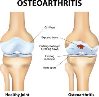 MRI was utilized to assessed cartilage degeneration in patients who lost weight over a 48-month period. MRI was utilized to assessed cartilage degeneration in patients who lost weight over a 48-month period.