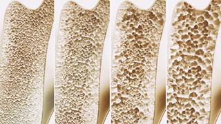 Four stages of osteoporosis. Four stages of osteoporosis.