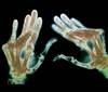 CVD in Rheumatoid Arthritis: How Can We Improve Diagnosis? CVD in Rheumatoid Arthritis: How Can We Improve Diagnosis?