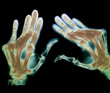 CVD in Rheumatoid Arthritis: How Can We Improve Diagnosis? CVD in Rheumatoid Arthritis: How Can We Improve Diagnosis?