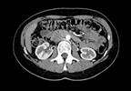 AKI After Computed Tomography Not Tied to Contrast AKI After Computed Tomography Not Tied to Contrast