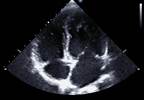 Rheumatoid Arthritis Increases Nonischemic Heart Failure Risk Rheumatoid Arthritis Increases Nonischemic Heart Failure Risk