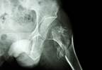 Single BMD, Fracture History Predicts Long-Term Fracture Risk in Older Women Single BMD, Fracture History Predicts Long-Term Fracture Risk in Older Women