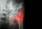Osteoporosis Drug Shows Cardioprotective Potential at 10-Year Follow-Up Osteoporosis Drug Shows Cardioprotective Potential at 10-Year Follow-Up