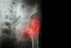 Osteoporosis Drug Shows Cardioprotective Potential at 10-Year Follow-Up Osteoporosis Drug Shows Cardioprotective Potential at 10-Year Follow-Up