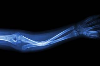 Significant reduction in vertebral and nonvertebral fractures were observed with the use of Abaloparatide. Significant reduction in vertebral and nonvertebral fractures were observed with the use of Abaloparatide.