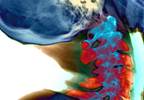 Second Biologic Effective in Rheumatoid Arthritis After Initial Treatment Failure Second Biologic Effective in Rheumatoid Arthritis After Initial Treatment Failure