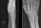 Postmenopause Osteoporosis Drug Denosumab Demonstrates Long-term Safety Postmenopause Osteoporosis Drug Denosumab Demonstrates Long-term Safety