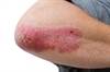 Increasing Body Surface Area Affected by Psoriasis May Increase T2D Risk Increasing Body Surface Area Affected by Psoriasis May Increase T2D Risk