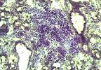 First Clinical Practice Guidelines for Sjögren's Syndrome Developed First Clinical Practice Guidelines for Sjögren's Syndrome Developed