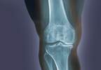 Patients With Osteoarthritic Knee Pain Benefit From Paracetamol Patients With Osteoarthritic Knee Pain Benefit From Paracetamol