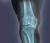 Ozone Safe, Effective for Knee Osteoarthritis Pain Ozone Safe, Effective for Knee Osteoarthritis Pain