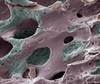 Consensus-Based Recommendations Released to Improve Osteoporosis Diagnosis, Treatment Consensus-Based Recommendations Released to Improve Osteoporosis Diagnosis, Treatment