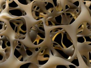 The study findings suggest that MS may be a secondary cause of osteoporosis. The study findings suggest that MS may be a secondary cause of osteoporosis.