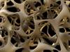 Association Between Osteoporosis and Multiple Sclerosis Association Between Osteoporosis and Multiple Sclerosis
