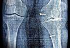 COX-2 Inhibitors Plus Metformin Lower Joint Replacement Rates in Osteoarthritis With T2D COX-2 Inhibitors Plus Metformin Lower Joint Replacement Rates in Osteoarthritis With T2D