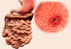Preferred Treatment to Reduce GI Bleeding Risk With NSAIDS in OA, RA Preferred Treatment to Reduce GI Bleeding Risk With NSAIDS in OA, RA