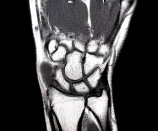 MRI is more sensitive than clinical markers for identifying radiographic disease progression. MRI is more sensitive than clinical markers for identifying radiographic disease progression.