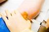 Superior Reduction in Osteoarthritis Knee Pain From Novel Hyaluronan Injection Superior Reduction in Osteoarthritis Knee Pain From Novel Hyaluronan Injection