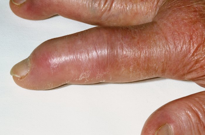 swelling reduce how gout Reduce Low Uric Gout Serum Risk Significantly Acid Levels