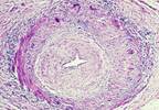 FDA Approves First Drug to Specifically Treat Giant Cell Arteritis FDA Approves First Drug to Specifically Treat Giant Cell Arteritis