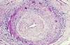Giant Cell Arteritis: Examining Challenges in Diagnosis and Treatment Giant Cell Arteritis: Examining Challenges in Diagnosis and Treatment