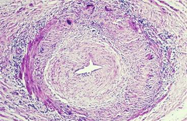 Giant Cell Arteritis: Examining Challenges in Diagnosis and Treatment Giant Cell Arteritis: Examining Challenges in Diagnosis and Treatment
