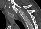 Gender Differences in Axial and Peripheral Spondyloarthritis Gender Differences in Axial and Peripheral Spondyloarthritis