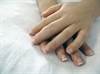 Clinical Features Identified in Enthesitis-Related Juvenile Idiopathic Arthritis, Juvenile Spondyloarthritis Clinical Features Identified in Enthesitis-Related Juvenile Idiopathic Arthritis, Juvenile Spondyloarthritis
