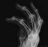 Psoriatic Arthritis Improved With Etanercept Therapy Psoriatic Arthritis Improved With Etanercept Therapy