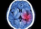 Anemia in Dialysis Patients Linked With Hemorrhagic Stroke Anemia in Dialysis Patients Linked With Hemorrhagic Stroke