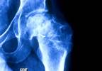 Antiphospholipid Score Validated as Risk Factor for Idiopathic Osteonecrosis of the Femoral Head in SLE Antiphospholipid Score Validated as Risk Factor for Idiopathic Osteonecrosis of the Femoral Head in SLE
