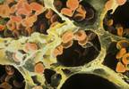 Diffuse Alveolar Hemorrhage in SLE Associated With Serious Disease Flare Diffuse Alveolar Hemorrhage in SLE Associated With Serious Disease Flare