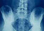 Challenges of Targeting Remission in Axial Spondyloarthritis Challenges of Targeting Remission in Axial Spondyloarthritis