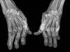 Rheumatoid Arthritis in the Elderly: A New Problem or an Old One? Rheumatoid Arthritis in the Elderly: A New Problem or an Old One?