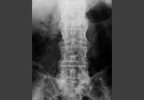 Functional Status in Early Axial Spondyloarthritis: The Role of Spinal Structural Damage Functional Status in Early Axial Spondyloarthritis: The Role of Spinal Structural Damage