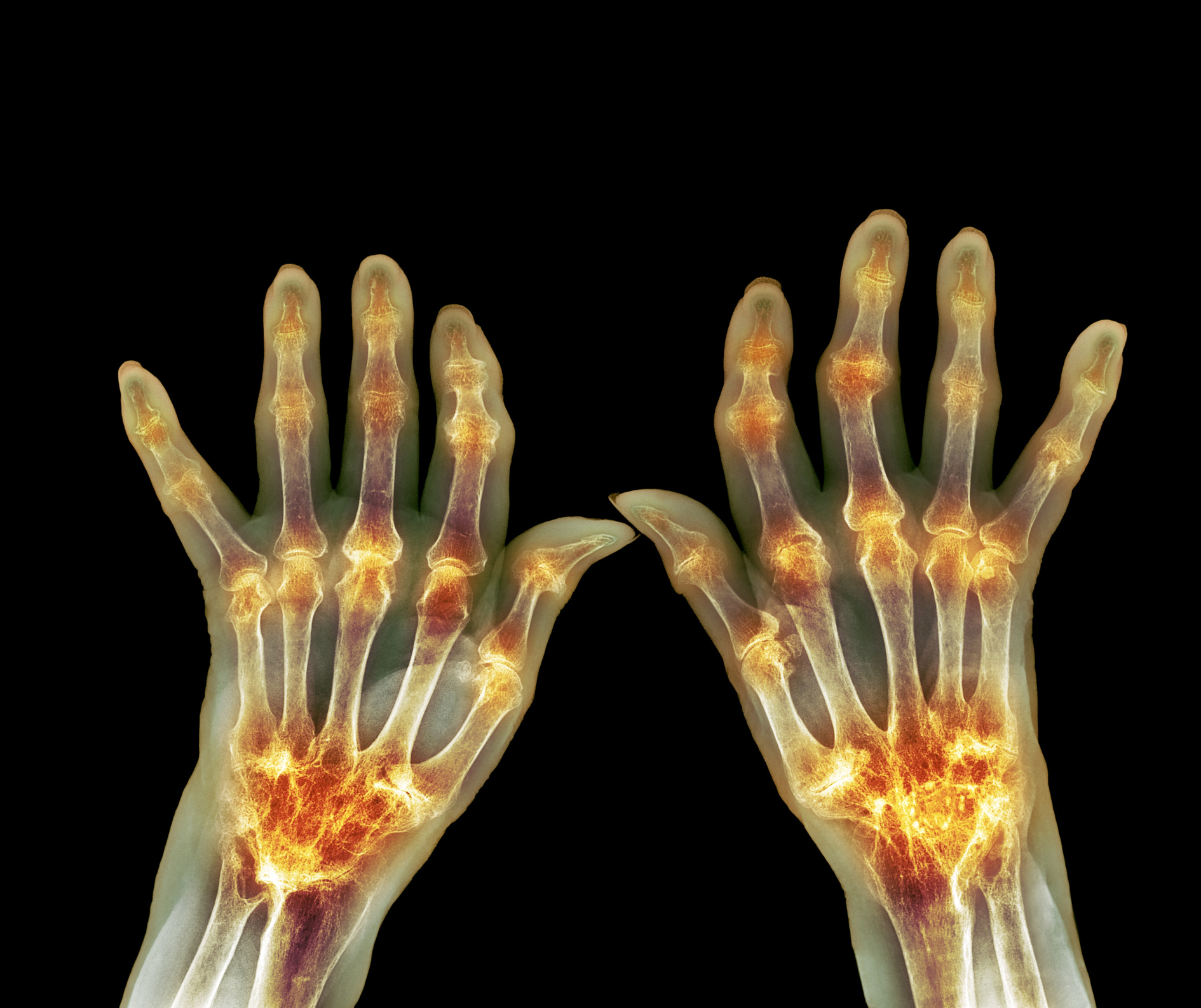 What Does Rheumatoid Factor Mean In A Blood Test